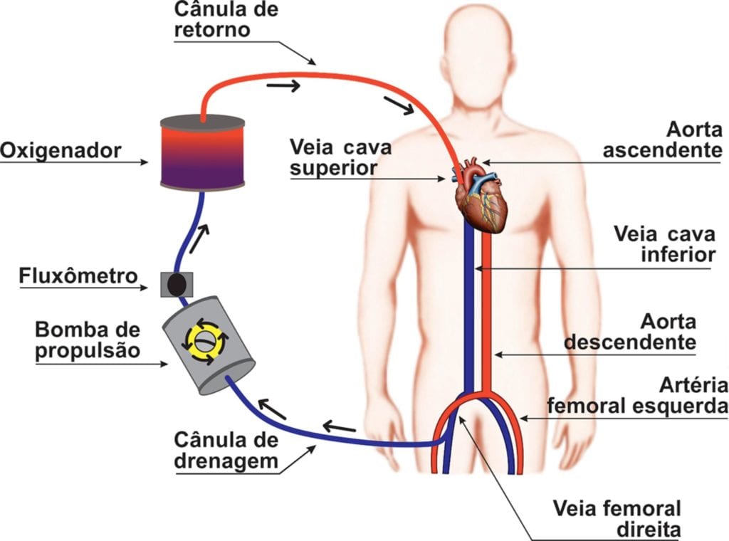 Circuito veno-venoso / Fonte: Extracorporeal membrane oxygenation: a literature review