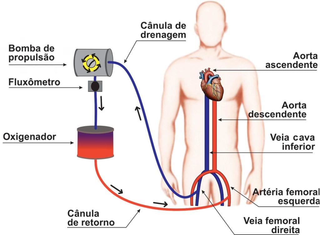 Circuito veno-arterial / Fonte: Extracorporeal membrane oxygenation: a literature review